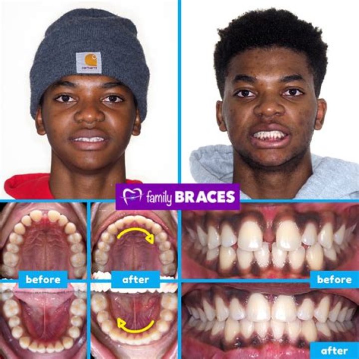 Cole Sprouse Teeth Before And After -Has He Used Braces And Whitened Them?